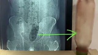 यौन आनंद की सनक पड़ी भारी युवक ने मलाशय में घुसा ली ऐसी चीज़, X-रे देख डॉक्टरों के उड़ गए होश, सर्जरी के बाद हुआ चौंकाने वाला खुलासा