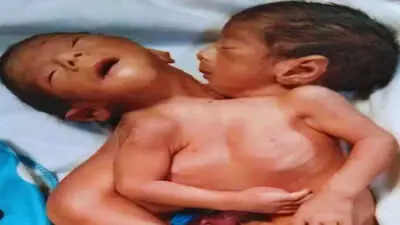 रुला देगी ये दर्दनाक कहानी, 2 सिर, 4 हाथ-पैर और एक धड़! अपने ही जुड़वां बच्चों को देख मां की मौत