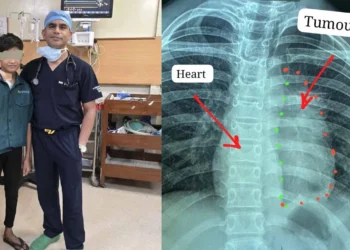 CG : 11 साल के बच्चे के दिल से चिपका दुर्लभ कैंसर निकाला, बना विश्व कीर्तिमान, 6 महीने पहले हुए कैंसर सर्जरी एवं 25 साइकिल रेडिएशन थेरेपी के बाद बच्चे ने इस साल स्कूल जाना प्रारंभ किया और परीक्षा भी दिया