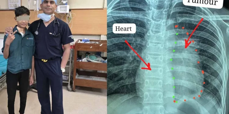 CG : 11 साल के बच्चे के दिल से चिपका दुर्लभ कैंसर निकाला, बना विश्व कीर्तिमान, 6 महीने पहले हुए कैंसर सर्जरी एवं 25 साइकिल रेडिएशन थेरेपी के बाद बच्चे ने इस साल स्कूल जाना प्रारंभ किया और परीक्षा भी दिया