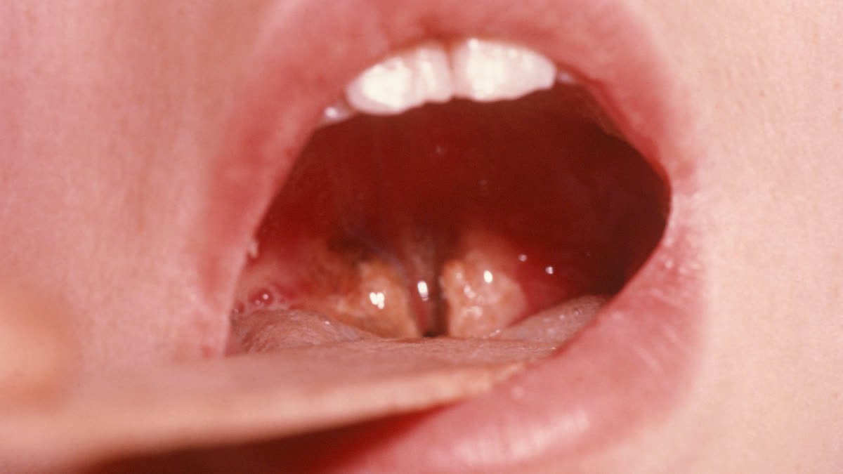 50 साल पुरानी जानलेवा बीमारी की हुई एंट्री, एक महीने में तीन गुना बढ़े मामले, जानिए क्या है ये बीमारी और इसके लक्षण