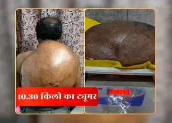 CG News : 15 साल से पीठ पर 10 किलोग्राम से ज्यादा वजनी ट्यूमर लेकर जिंदगी जी रहा था युवक, अम्बेडकर अस्पताल के डॉक्टरों की दी नई जिंदगी