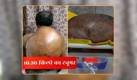 CG News : 15 साल से पीठ पर 10 किलोग्राम से ज्यादा वजनी ट्यूमर लेकर जिंदगी जी रहा था युवक, अम्बेडकर अस्पताल के डॉक्टरों की दी नई जिंदगी