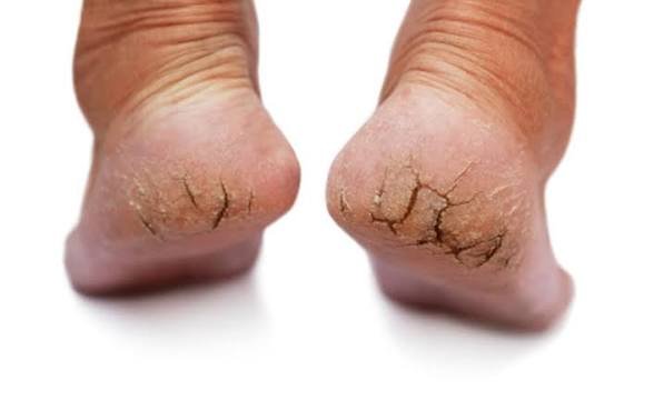 फटी एड़ियों से हैं परेशान? तो जरूर आजमाएं ये आसान नुस्खे